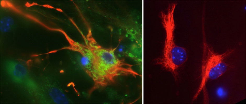 A brain astrocyte cell (colored red) infected with Zika virus, shown in green (left panel), alongside an uninfected astrocyte (right panel)